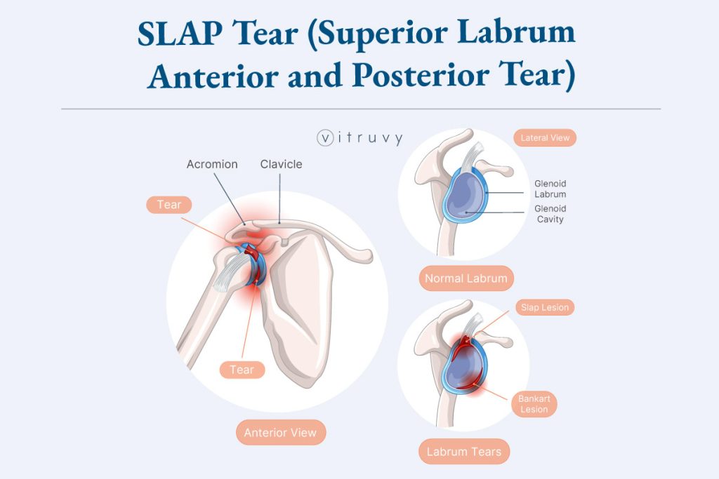 SLAP tear medical illustration of the shoulder