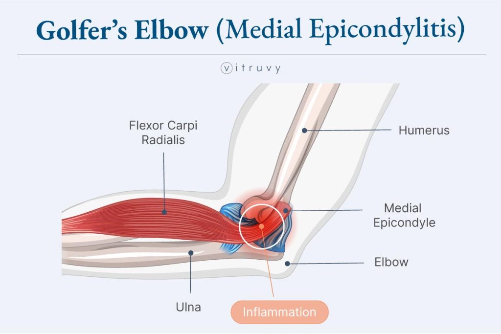 golfer's elbow medical illustration