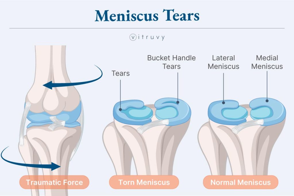 Understanding Knee Pain And Common Knee Injuries Vitruvy Understanding Knee Pain And Common Knee Injuries Vitruvy