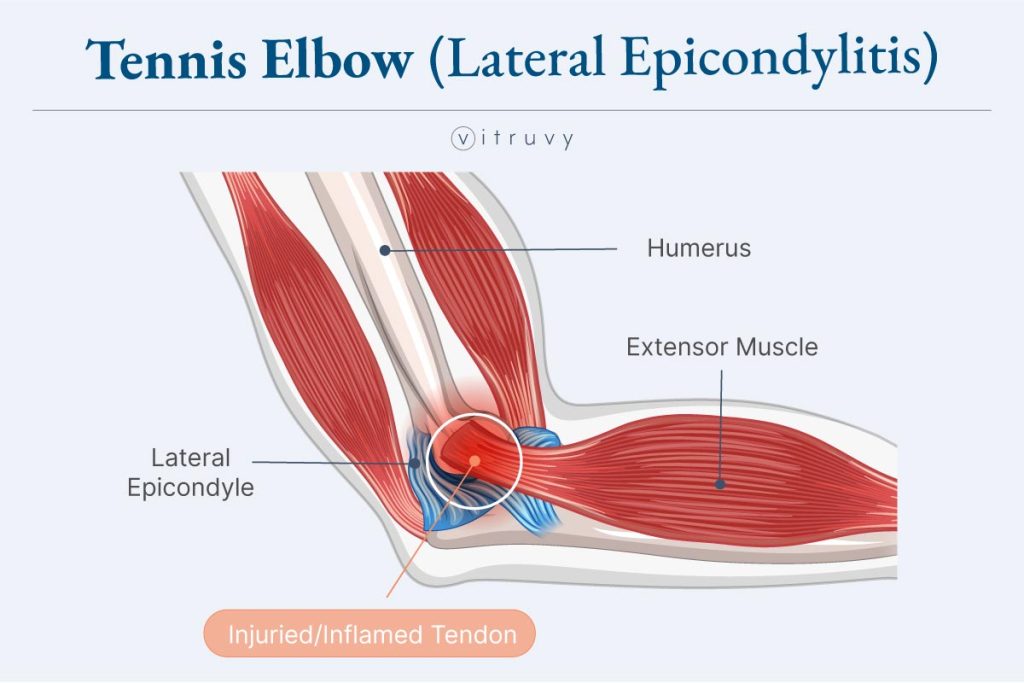 medical illustration of tennis elbow looks like