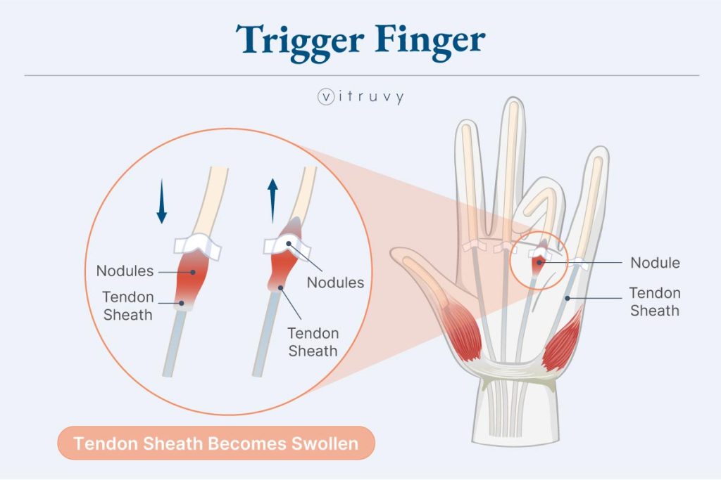 trigger finger medical illustration