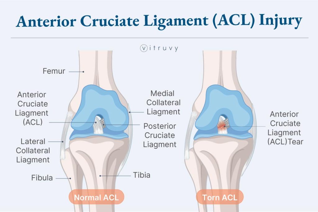 Medical illustration of an ACL injury