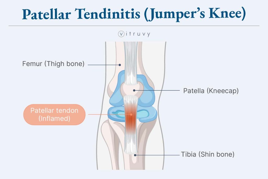Patellar Tendinitis (Jumper's Knee) diagram
