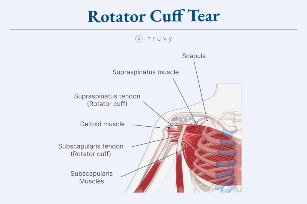 Rotator Cuff Tear diagram