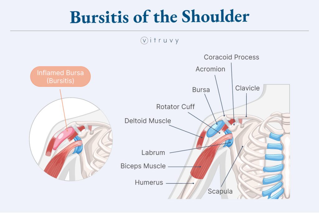Diagram of Bursitis of the Shoulder