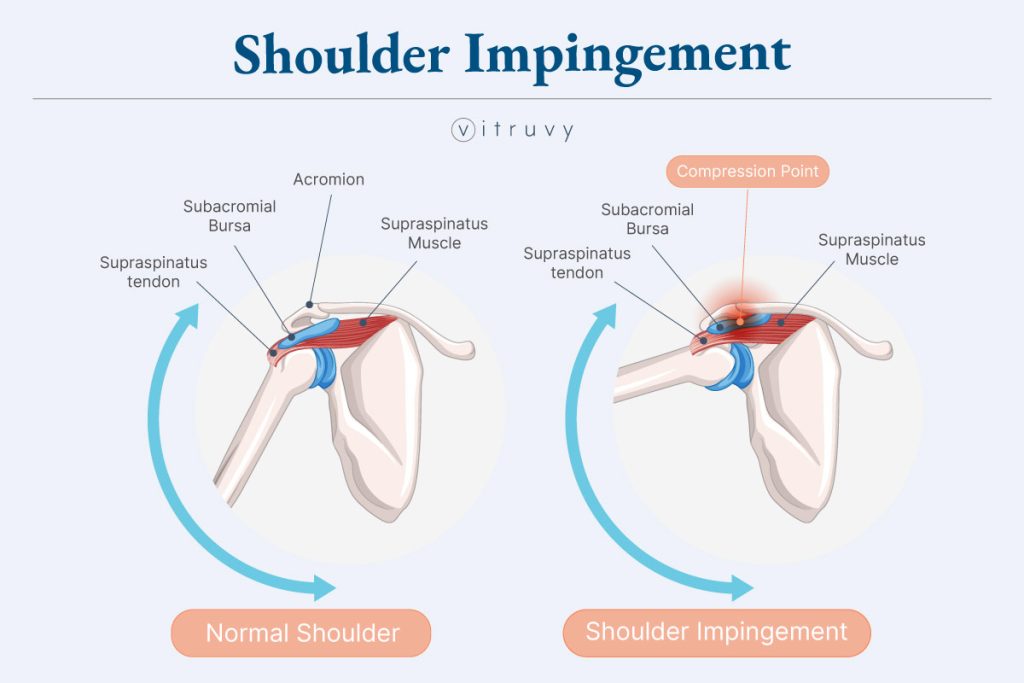 Illustration of a normal shoulder interior compared to a shoulder with impingement.