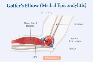 an illustration of golfer's elbow