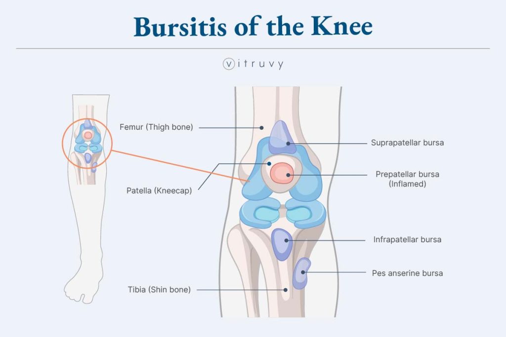 Medical illustration of the knee joint highlighting bursae affected by knee bursitis 